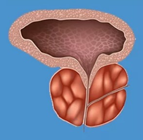 Some of the characteristic signs of prostatitis