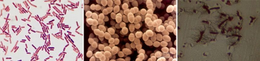 E. coli, fecal enterococcus and proteus are the main causative agents of chronic bacterial prostatitis