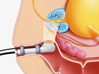 Needle biopsy of the prostate.