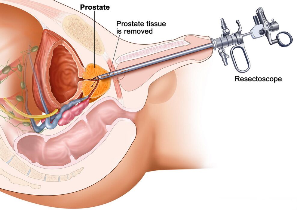 Collection of prostate tissue for an accurate diagnosis of prostatitis